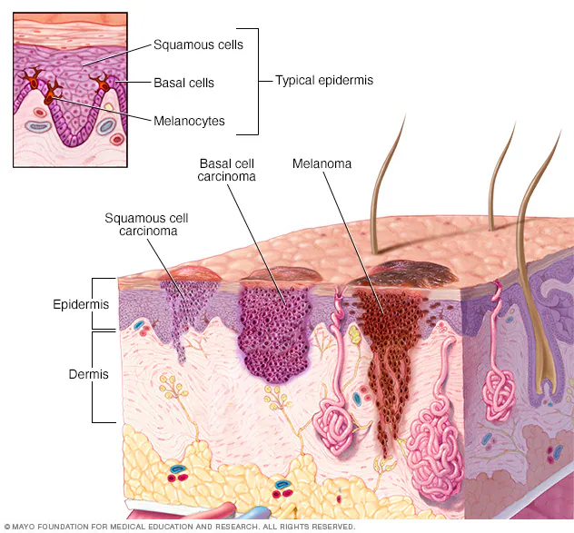 Skin Cancers